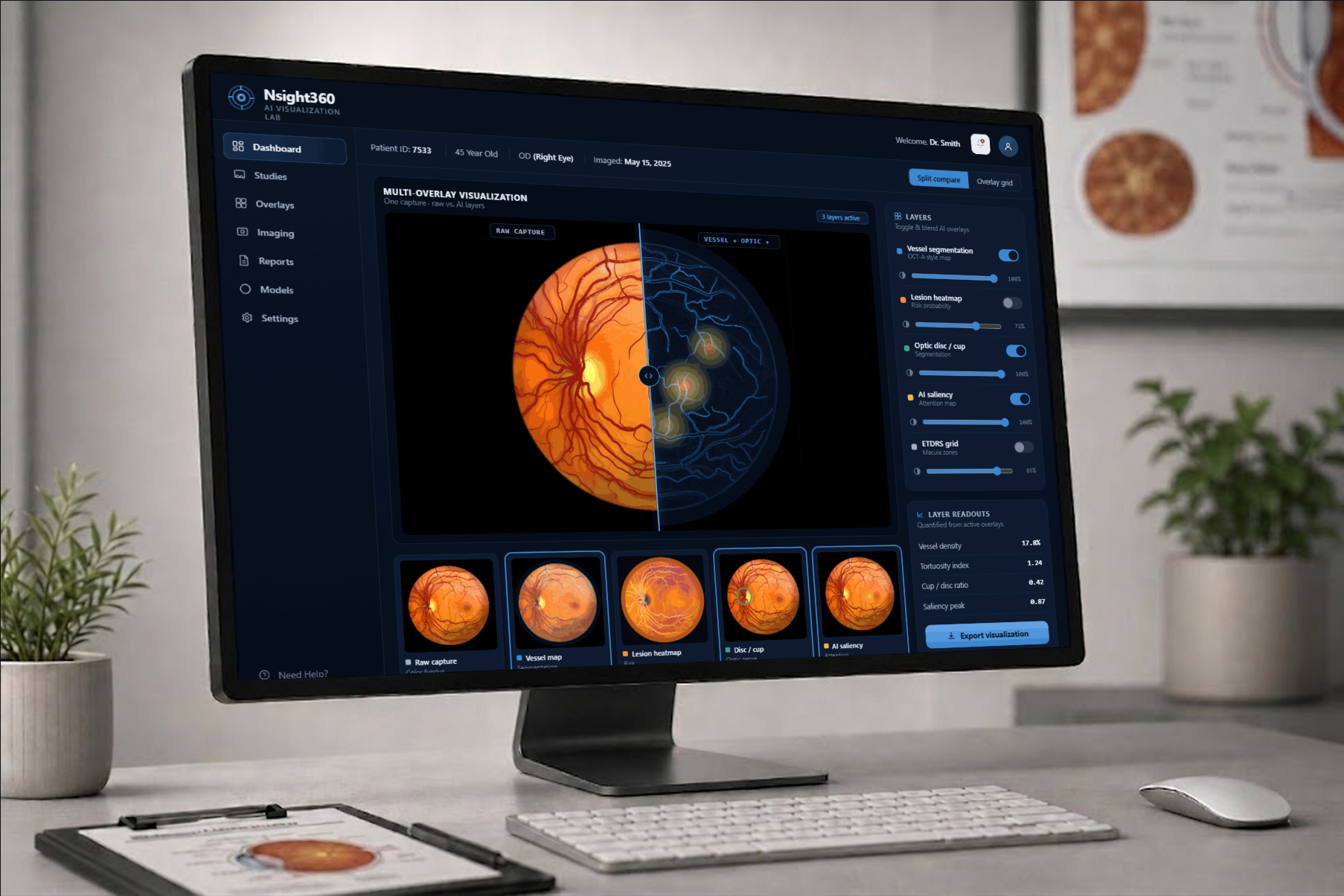 Nsight360 AI Visualization Lab — multi-overlay retinal analysis dashboard on a desktop monitor